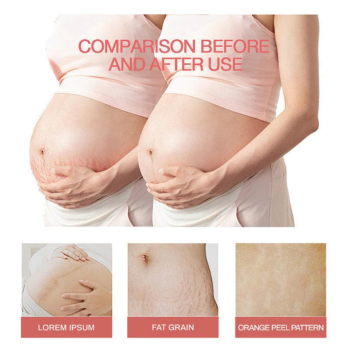 š„AQA new natural formula essential oil stretch mark cream for pregnant women